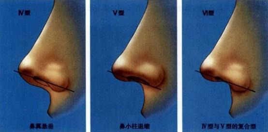 鼻小柱延長(zhǎng)術(shù)一般價(jià)位多少錢？做鼻小柱延長(zhǎng)術(shù)有什么不好的影響嗎？