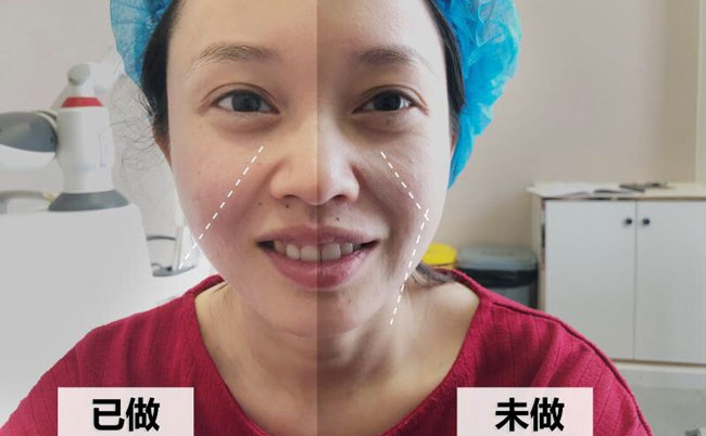 激光溶脂瘦臉的副作用及效果？光纖溶脂瘦臉多久可以見效？