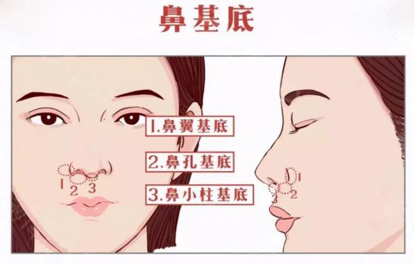 自體脂肪填充鼻基底好不好？鼻基底脂肪填充多久恢復(fù)？