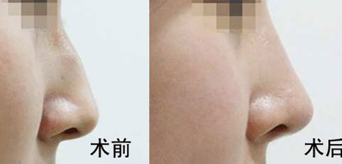 駝峰鼻矯正的方法有哪些？駝峰鼻矯正的方式及適合人群？