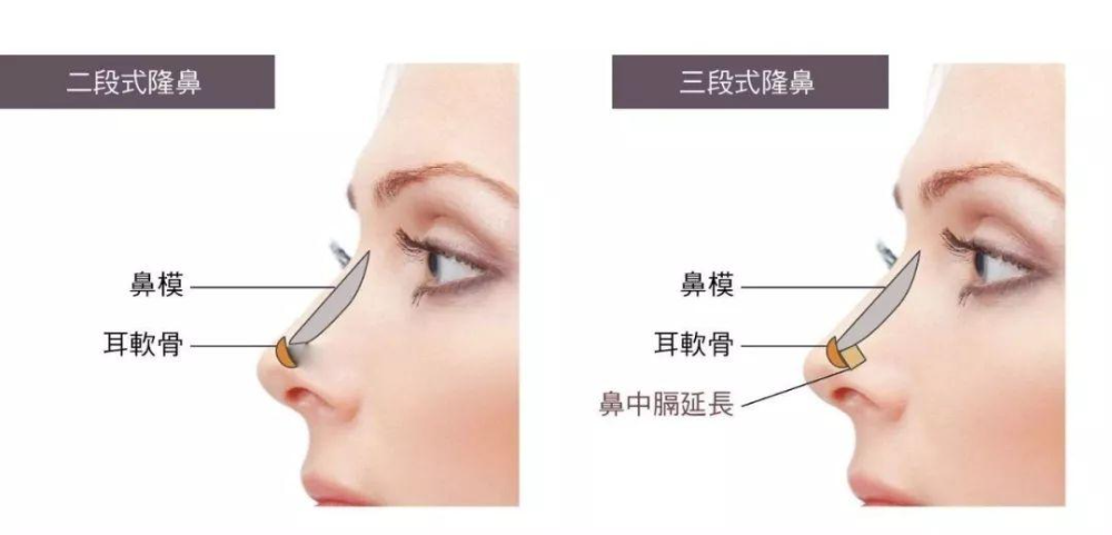 自體軟骨隆鼻的手術(shù)優(yōu)缺點(diǎn)有哪些？肋軟骨填充鼻基底多久能自然？