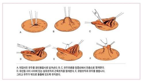 乳頭內(nèi)陷矯正手術(shù)多少錢？乳頭內(nèi)陷矯正手術(shù)多久可以恢復？