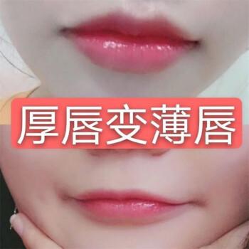 厚唇改薄整形手術(shù)價(jià)格？厚唇改薄多久完全恢復(fù)？