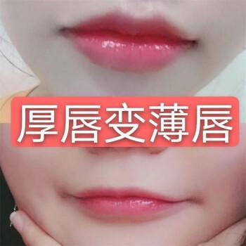 厚唇改薄整形手術(shù)價格？厚唇改薄多久完全恢復(fù)？