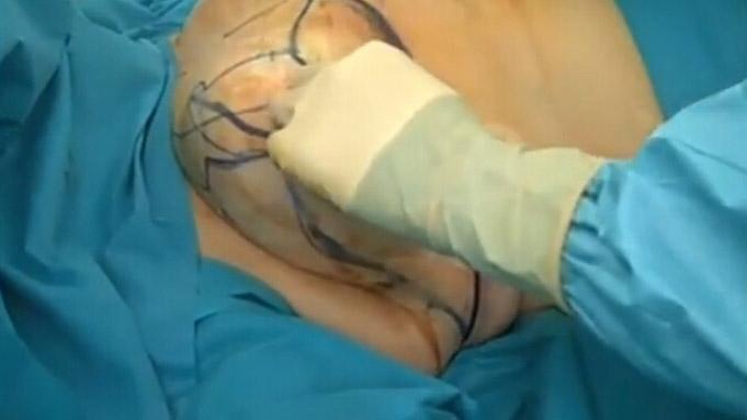 乳房縮小手術(shù)要多少錢？乳房縮小術(shù)是大手術(shù)嗎？