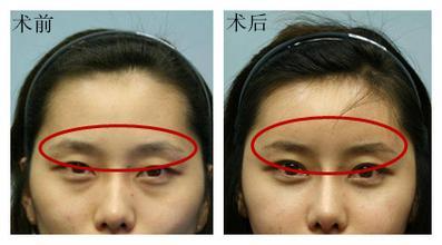 自體脂肪填充眉弓安全嗎？自體脂肪填充是永久的嗎？