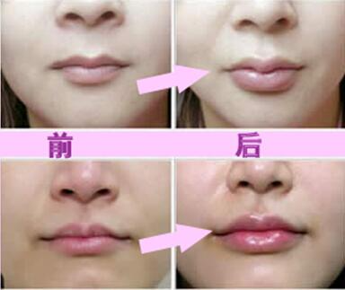 玻尿酸豐唇珠效果怎么樣？玻尿酸豐唇珠多少錢？