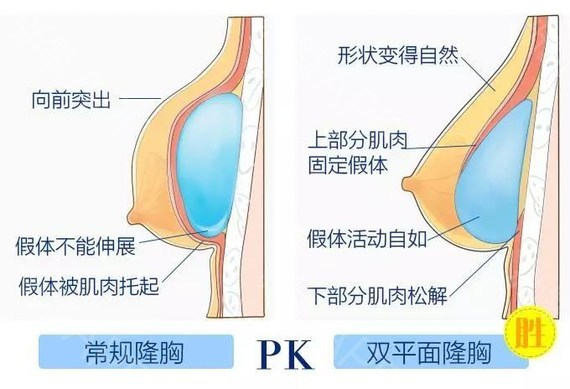 假體隆胸修復(fù)怎么做？做隆胸修復(fù)能維持多久？