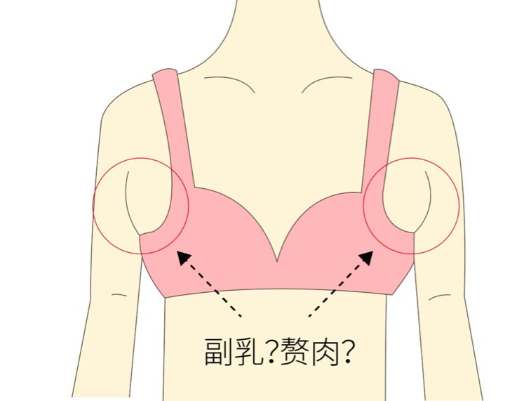 手術(shù)去副乳效果怎么樣？手術(shù)去副乳要注意什么？
