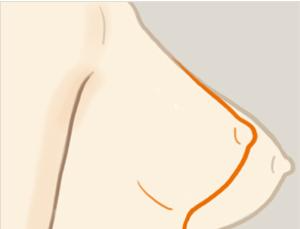 乳房下垂矯正手術(shù)風(fēng)險(xiǎn)有多大？ 乳房下垂矯正術(shù)多久能恢復(fù)？