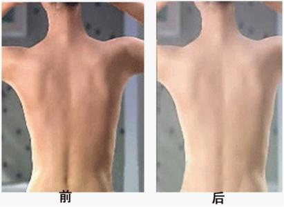 背部吸脂多久恢復？吸脂瘦背部注意事項