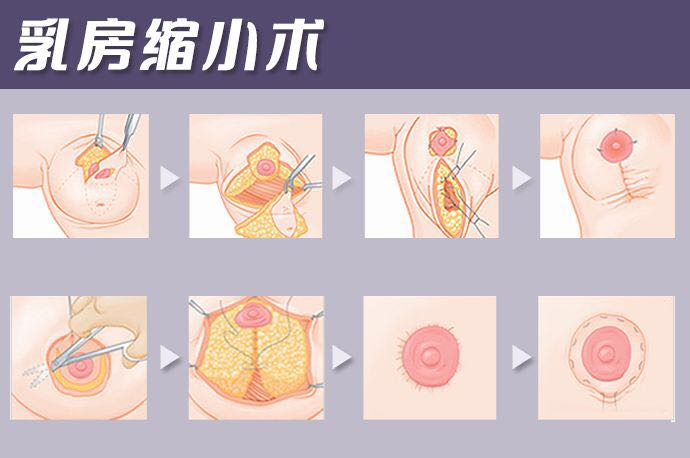 女性乳房縮小多少錢 ？女性乳房縮小住院幾天？
