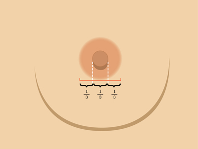 乳暈縮小如何矯正 乳暈縮小術(shù)的注意事項有哪些？
