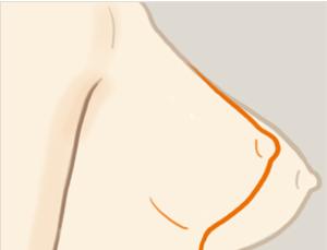 乳房下垂矯正手術(shù)風(fēng)險(xiǎn)有多大？ 乳房下垂矯正術(shù)多久能恢復(fù)？