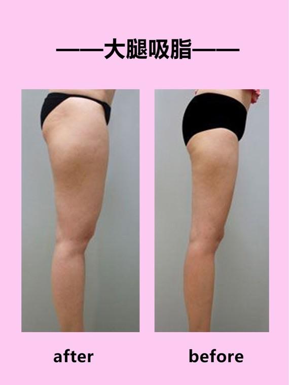 吸脂瘦大腿腫脹期是多久？大腿吸脂有什么后遺癥嗎？