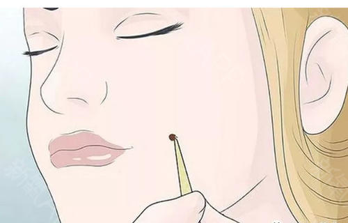 激光點痣要多久才會恢復？激光點痣多少錢？