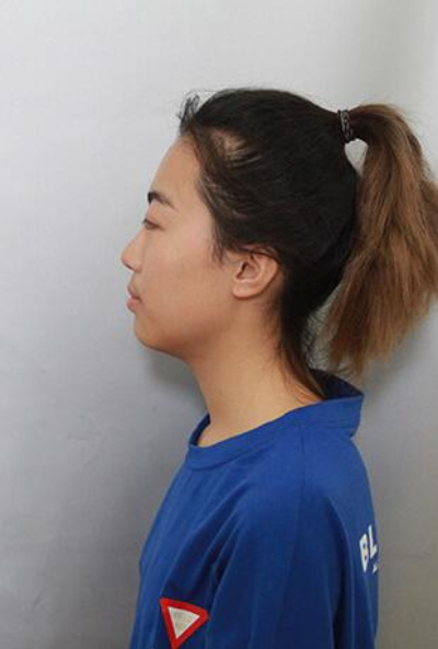  上海美萊醫(yī)療美容門診部做隆胸手術前的狀態(tài)