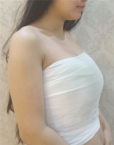 慈溪悅爾醫(yī)學美容醫(yī)院張庸柱隆胸案例效果分享