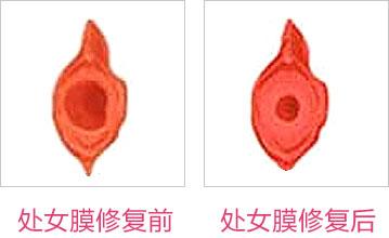 成都東方整形處女膜修復(fù)怎么樣？處女膜修復(fù)術(shù)后如何護理？