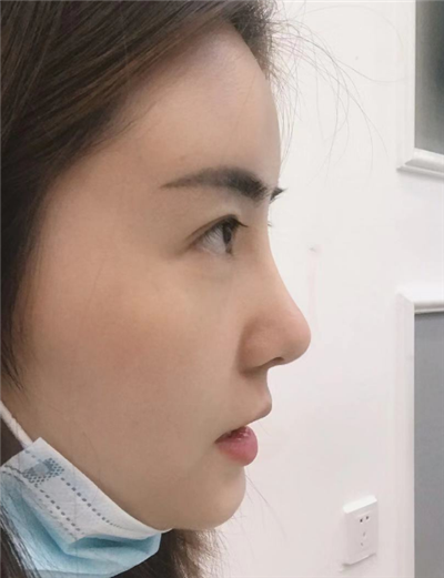 煙臺(tái)壹美整形美容醫(yī)院做隆鼻術(shù)后的最終效果