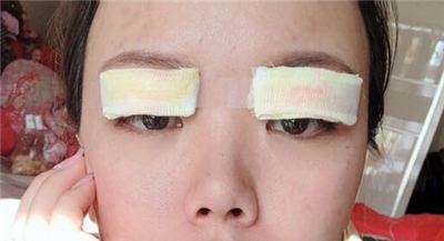 珠海韓妃醫(yī)療美容門(mén)診部做雙眼皮手術(shù)后的情形