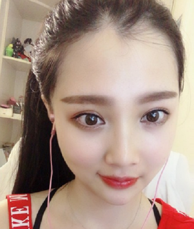 鄭州麗天整形美容醫(yī)院做面部吸脂手術(shù)后的半個月