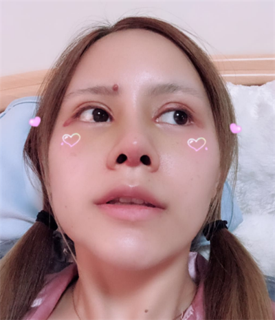 深圳弘美醫(yī)療美容門(mén)診部做眼綜合手術(shù)后的恢復(fù)情況