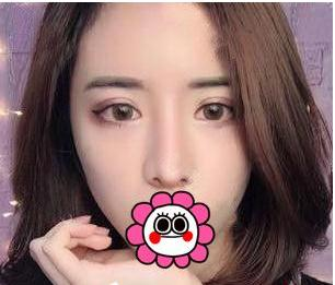 有“鼻王”之稱的楊群申做鼻子到底怎么樣？隆鼻前后圖片