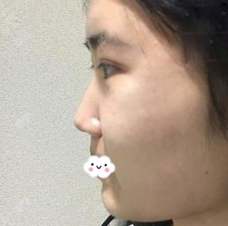 假體隆鼻假嗎？假體隆鼻三個(gè)月效果分享
