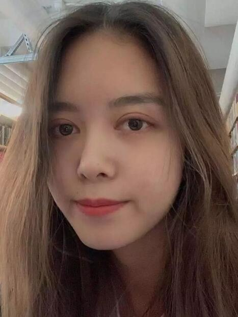 做雙眼皮案例，鄭州壹加壹王洛生全切雙眼皮案例圖片