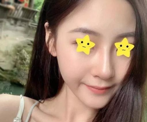 做綜合鼻，上海首爾麗格安建榮鼻綜合真人案例照片