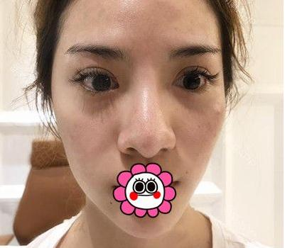 有“鼻王”之稱的楊群申做鼻子到底怎么樣？隆鼻前后圖片