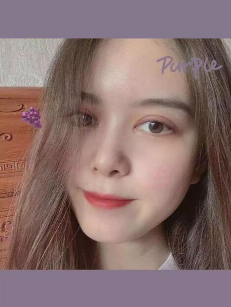 鄭州壹加壹王洛生全切雙眼皮案例術(shù)后三個月