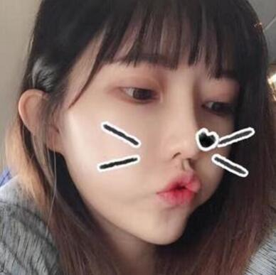 做雙眼皮案例，第四軍醫(yī)大學(xué)唐都醫(yī)院李望舟雙眼皮案例圖片