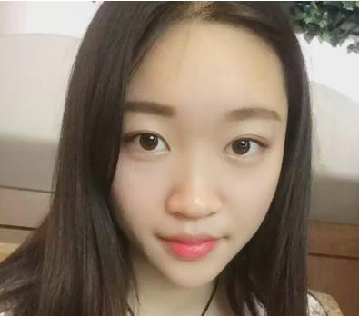 宜昌奧萊楊群申超體隆鼻案例分享，有圖