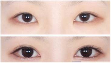 桂林柏琳整形開內(nèi)眼角多少錢？開內(nèi)眼角注意哪些?