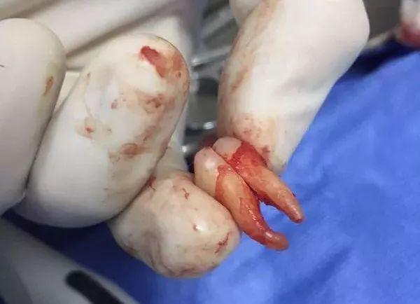 福州登特口腔拔智齒有哪些利弊？拔智齒有哪些情況？