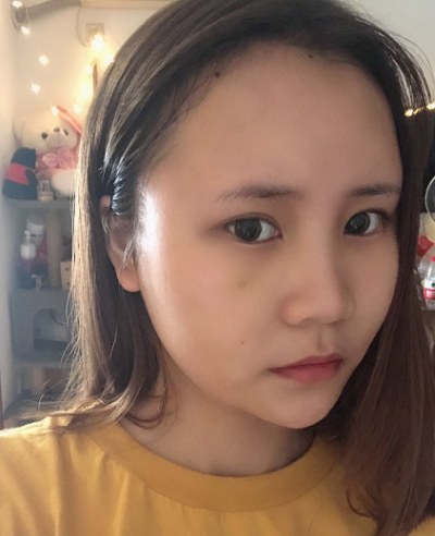 上海美萊醫(yī)療美容門診部做面部填充術(shù)后的日?；謴?fù)