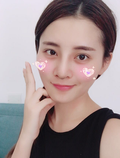 深圳微姿醫(yī)療美容門診部做鼻綜合手術拆線后第三天