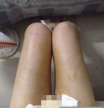  東莞華美醫(yī)療美容醫(yī)院做大腿吸脂手術后的一個月