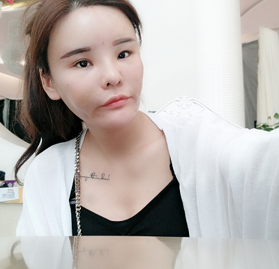 上海美萊醫(yī)療美容門診部做面部填充手術(shù)后的日?；謴?fù)